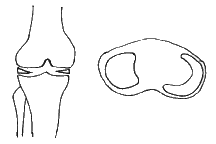 lateral discoid meniscus