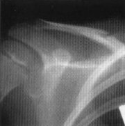 Fracture clavicle